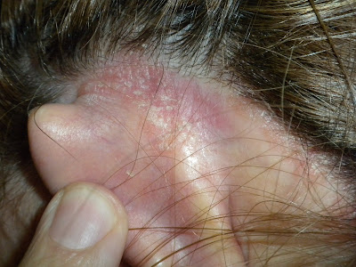 La salud siberiana los productos de la psoriasis